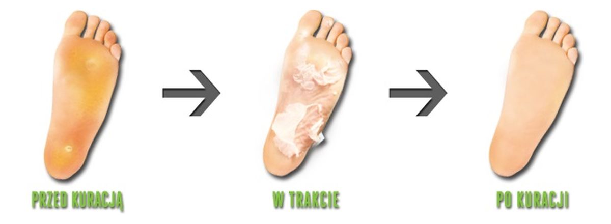 Kuracja Złuszczająca Do Stóp Skarpetki Złuszczajace